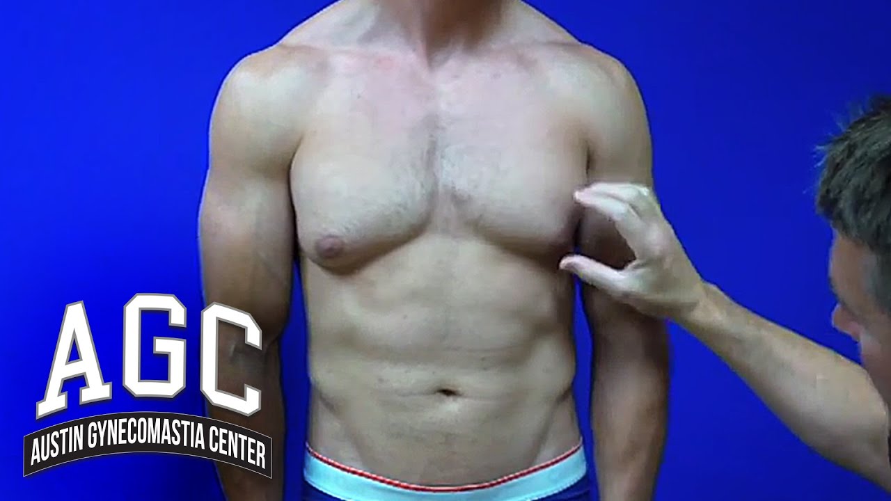 Gynecomastia treatment explained video