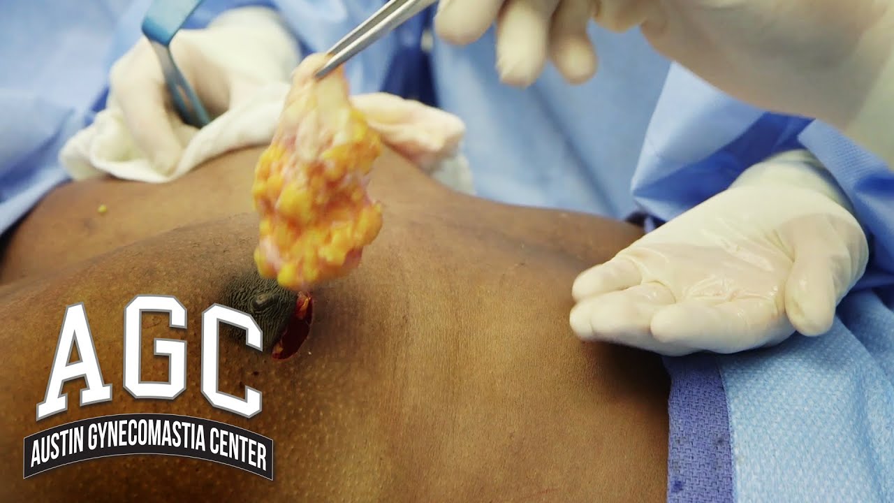 Glands removed in Gynecomastia treatment video