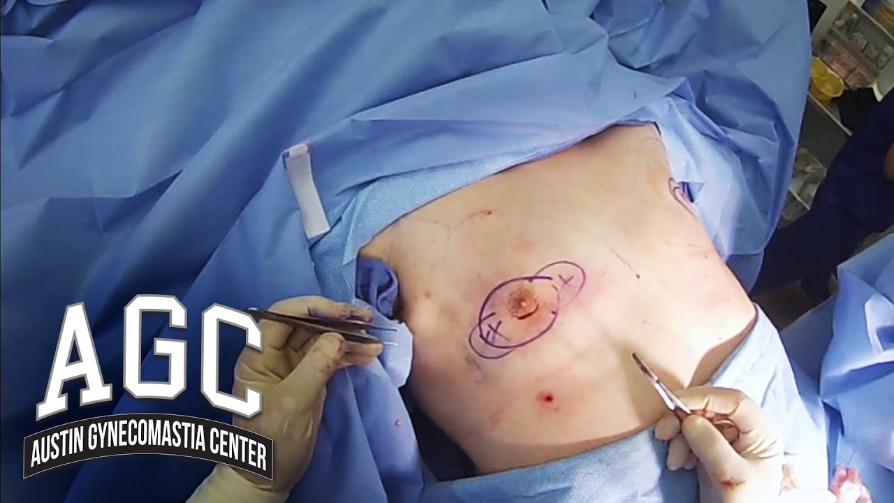 Full zone Gynecomastia surgery video