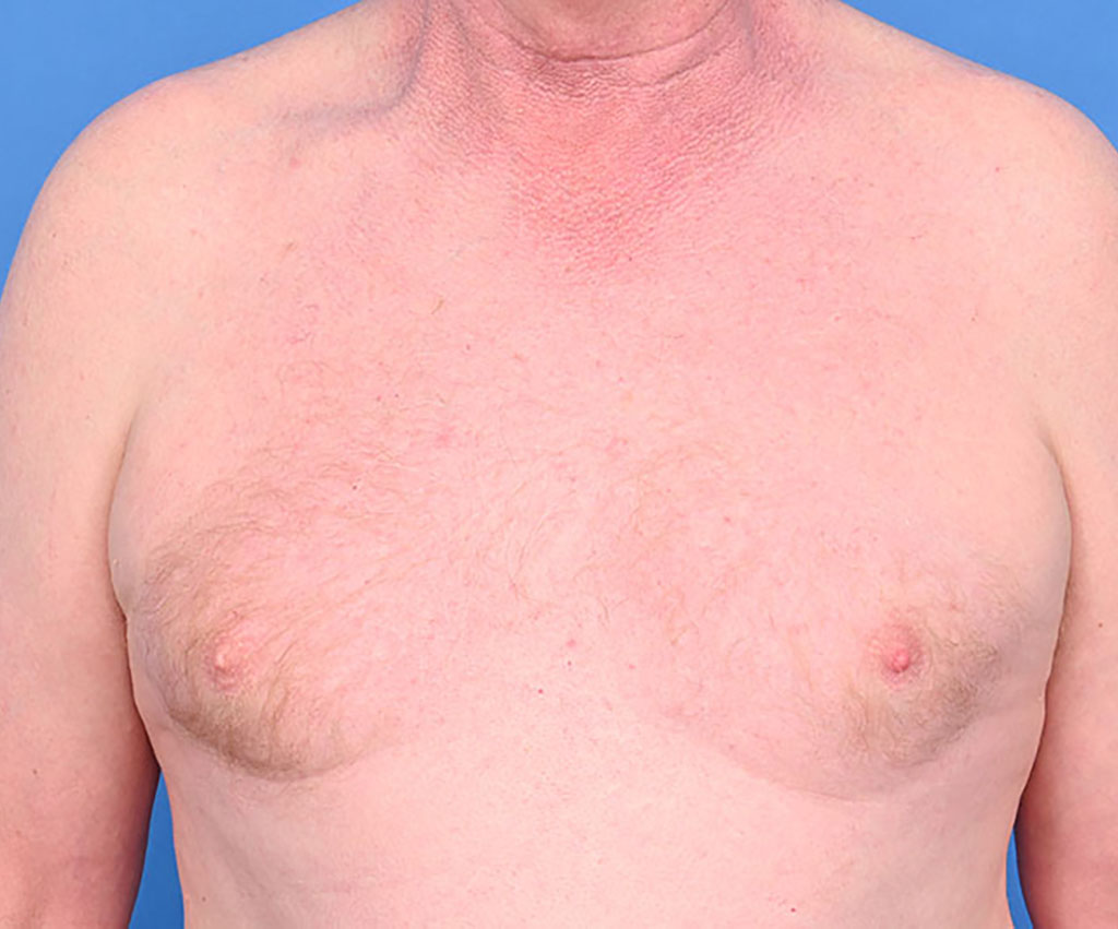 What Is Gynecomastia? Understanding This Common but Overlooked Condition in Men