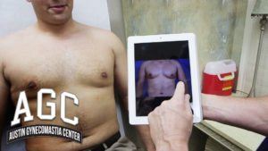 How It Feels To Not Have Gynecomastia video thumbnail