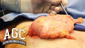 Video still showing asymmetrical gynecomastia treatment success