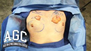 Removing gynecomastia from prohormones video thumbnail