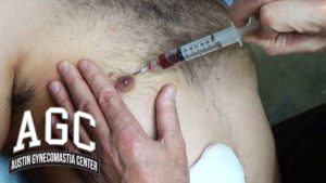 Seroma formation after gynecomastia surgery video
