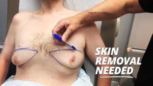 Video on XXL gynecomastia surgery showing when skin removal helps