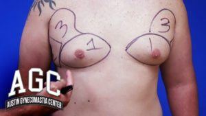 Zones of Gynecomastia