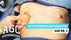 Ask Dr. C explains pseudogynecomastia and chest fat