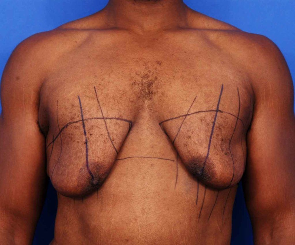 Male chest before gynecomastia treatment with sagging tissue