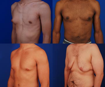 Group of men supporting one another through gynecomastia treatment