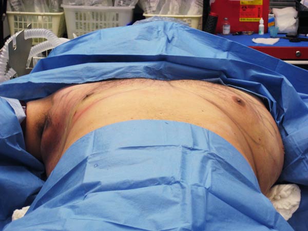 Chest contouring gynecomastia treatment