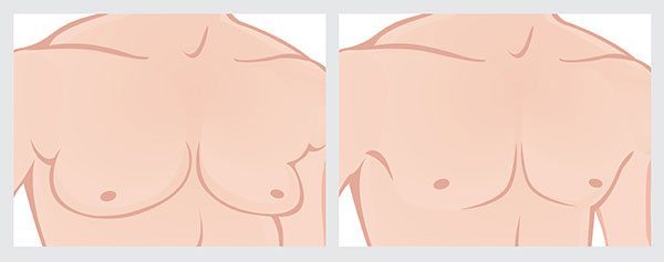Illustration explaining male chest with gynecomastia