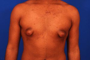 Patient chest showing tubular gynecomastia
