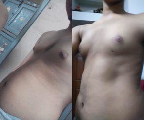 Indian gynecomastia patient