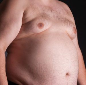 Gynecomastia sign on male chest
