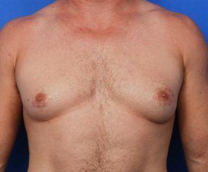 Signs of gynecomastia
