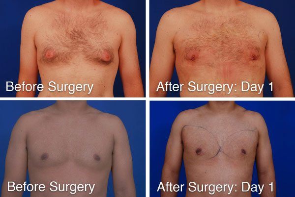 Day one results after gynecomastia surgery