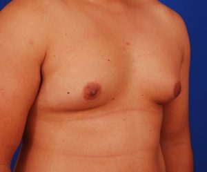 Man slouching to hide gynecomastia chest