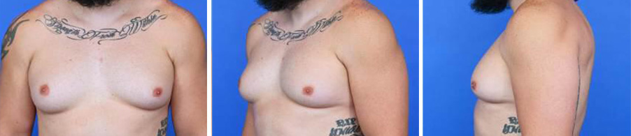 Before and after photos of chest