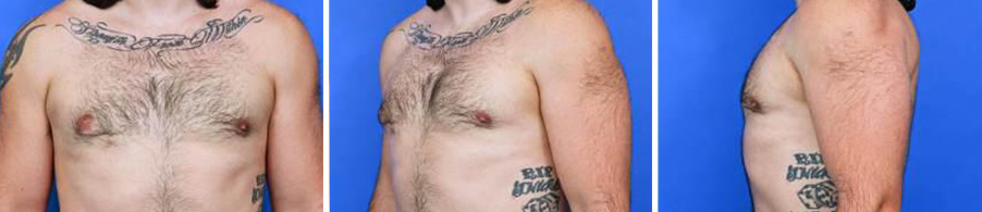 Before and after photos of chest