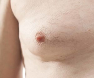 Breast lumps from gynecomastia