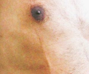 Mondor's disease developed after gynecomastia surgery