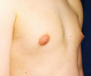 Illustration of puffy nipples caused by gynecomastia