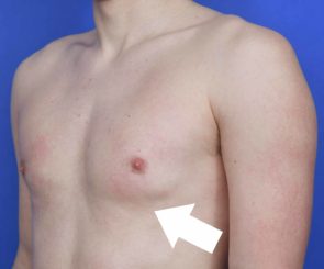 signs of gynecomastia