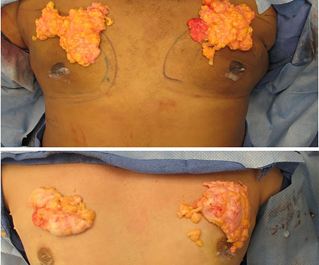 Types of Gynecomastia Tissue