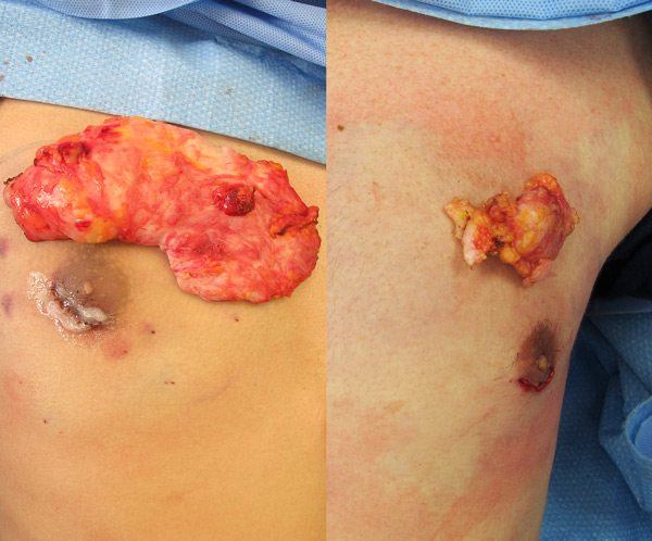 Vaser gynecomastia gland before and after shrinking