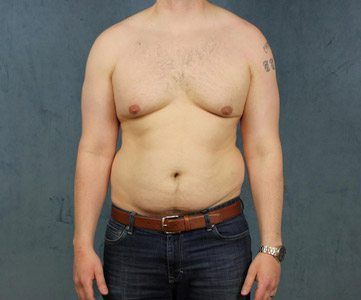 Gynecomastia patient before corrective surgery