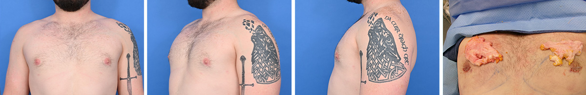 Before and after gynecomastia revision surgery photos