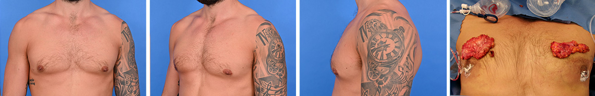 Additional gynecomastia revision results showing flatter chest