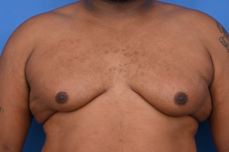 Male chest after gynecomastia surgery