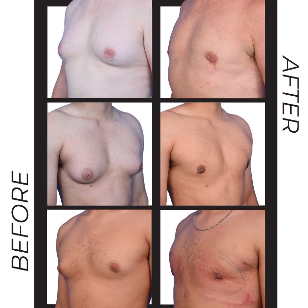Patient showing chest contour after surgery