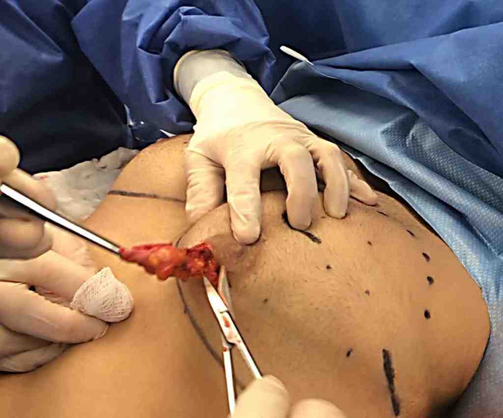 Man hiding chest before gynecomastia surgery