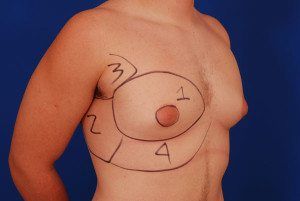The gynecomastia Zone Classification System