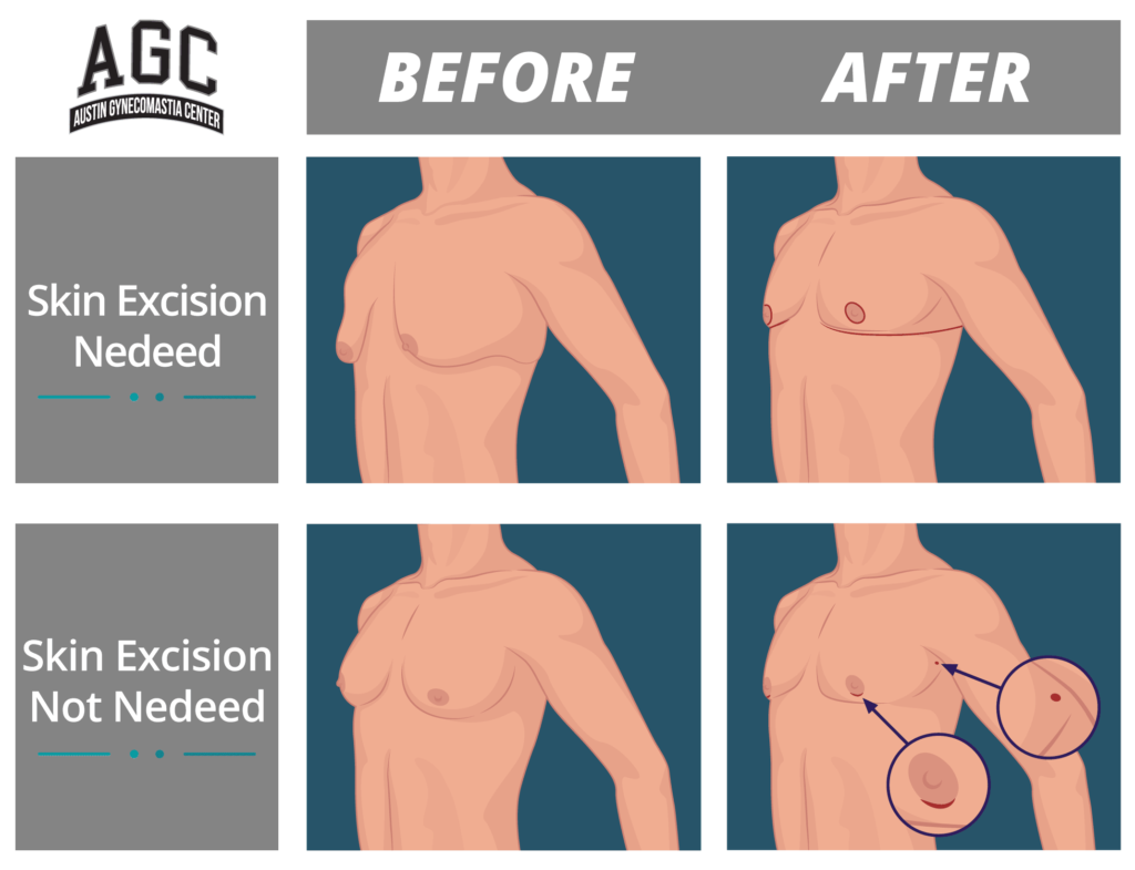 Skin excision illustration for gynecomastia surgery