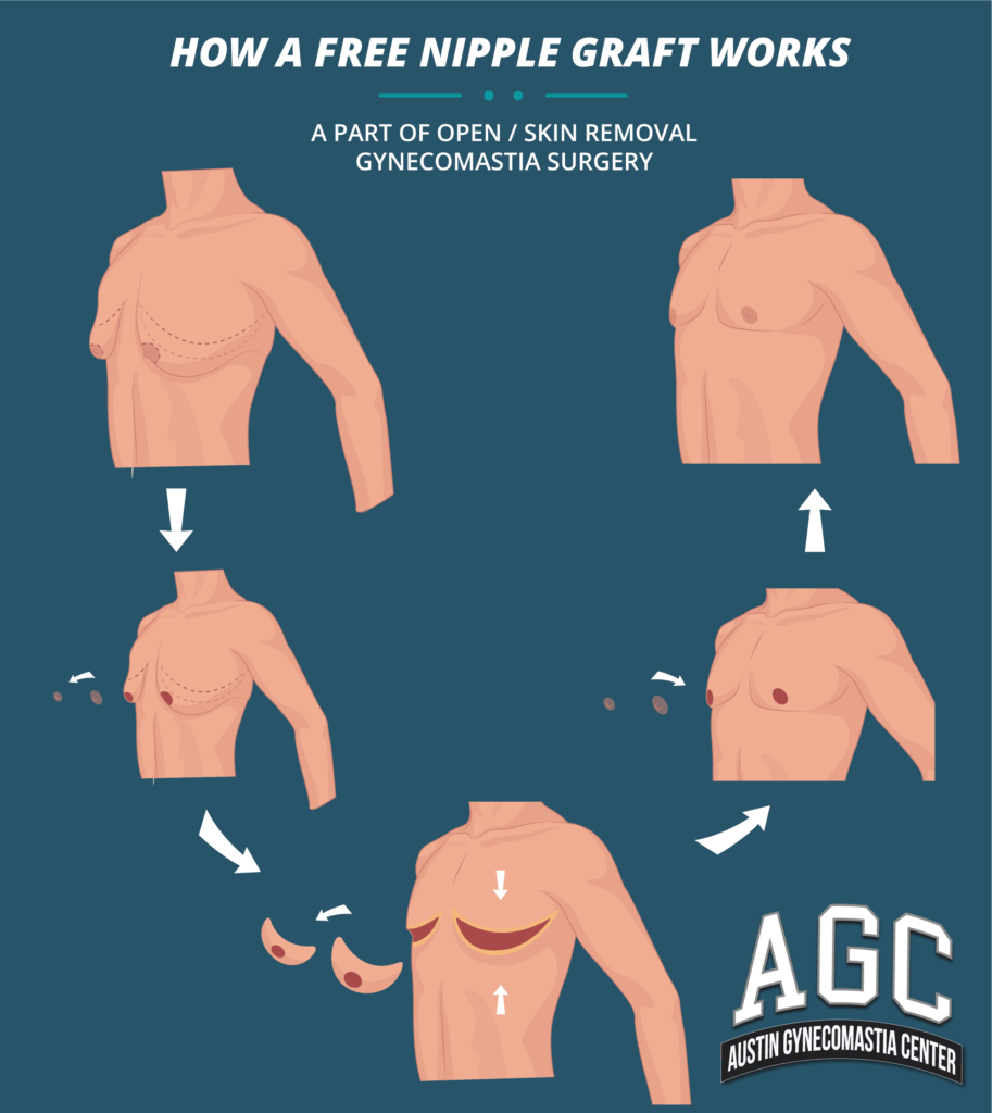 Skin removal gynecomastia surgery diagram